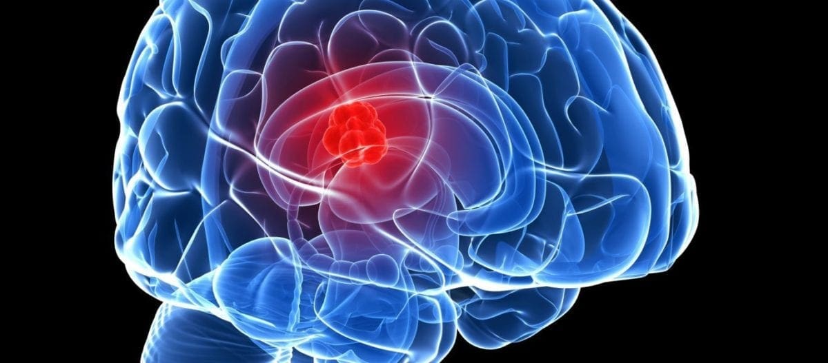 Μίνι εγκεφαλικό